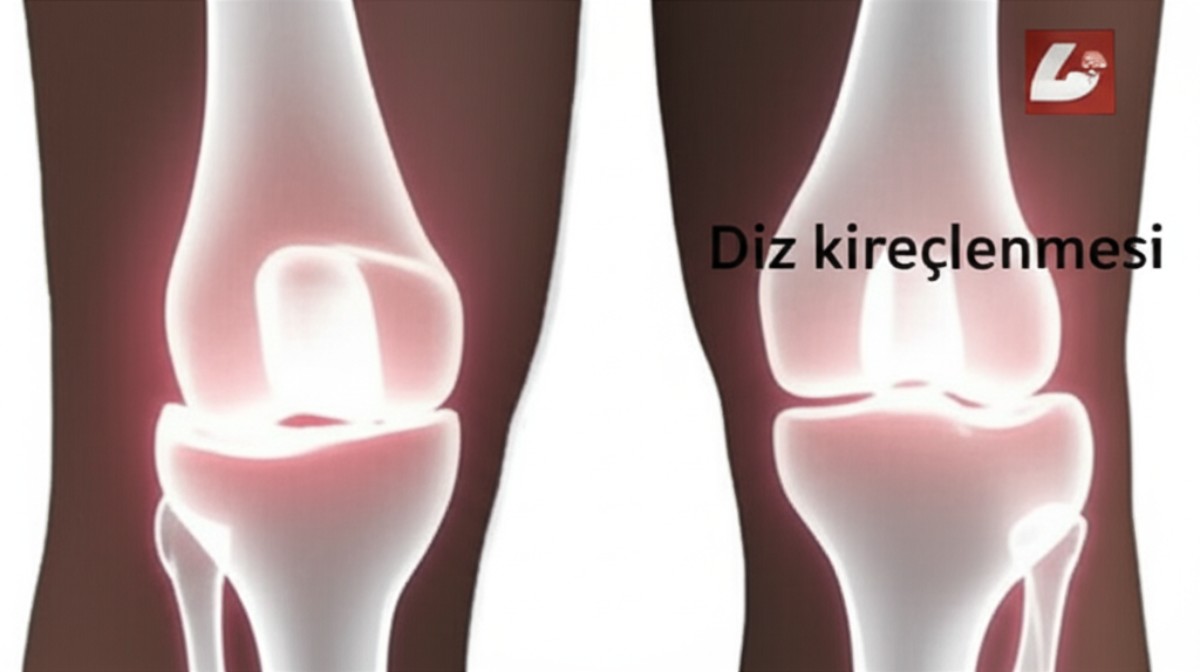 Diz Kireçlenmesi Nedir?